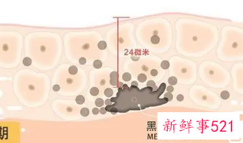 色斑是怎么形成的