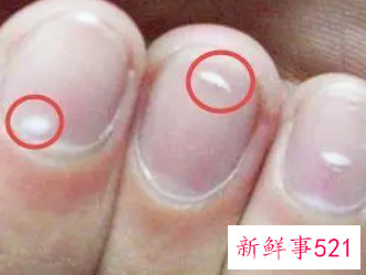 手指头有白点