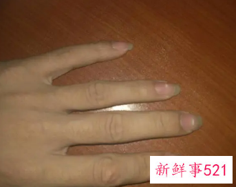 手指头有白点