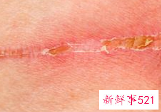 伤口长疤了里面还有脓