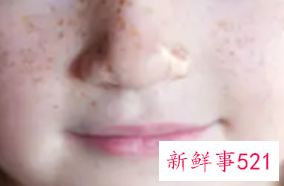 小女孩脸上有斑点是怎么回事