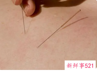 针灸的危害有