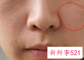 引起毛孔粗大的原因有哪些