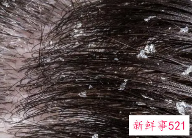 洗了头还有很多头皮屑怎么办