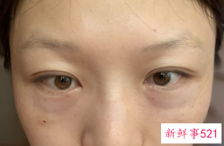 去泪沟最好的方法有哪些