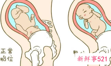 臀位转头位什么感觉