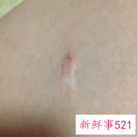 面部跌伤怎样快速去疤痕