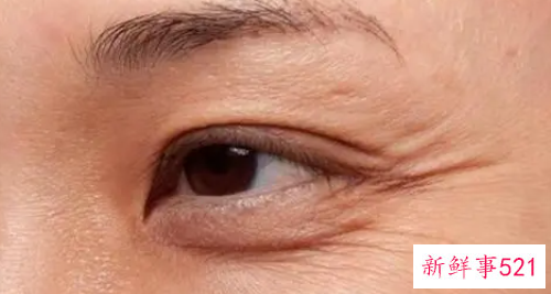 眼睛有皱纹如何消除