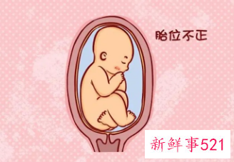 臀位转头位什么感觉