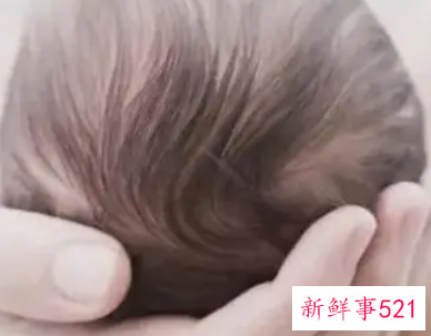 婴儿枕秃多久恢复正常