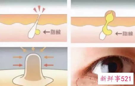 如何预防脂肪粒的出现