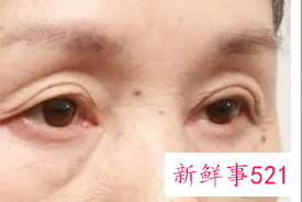 眼皮下垂怎么治最快方法