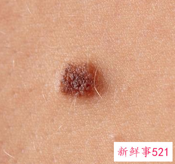 祛痣十天后痂没掉能洗脸吗