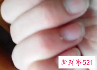 手指头有白点