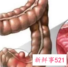 怎么判断自己有肠炎