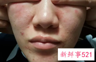 为什么化妆过后脸会痒