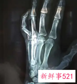 手指骨头疼痛是什么原因