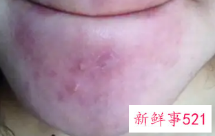 脂溢性皮炎一天洗几次脸