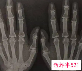 手指骨头疼痛是什么原因