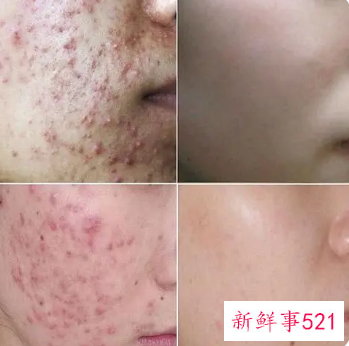 面部祛痘专业推销及话术