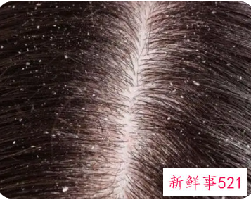 洗了头还有很多头皮屑怎么办