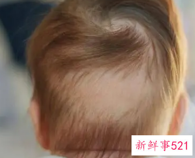 婴儿枕秃多久恢复正常