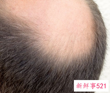 婴儿枕秃多久恢复正常