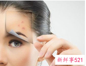 闭口粉刺是什么原因引起的