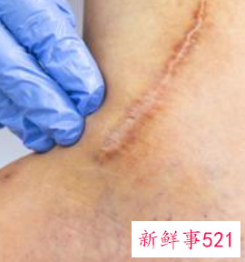 伤口长疤了里面还有脓