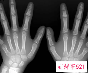 手指骨头疼痛是什么原因