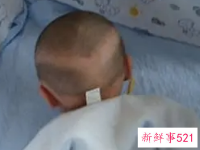婴儿枕秃多久恢复正常