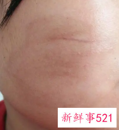 面部跌伤怎样快速去疤痕