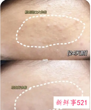 闭口粉刺是什么原因引起的