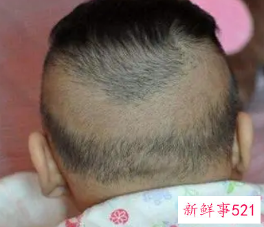 婴儿枕秃多久恢复正常