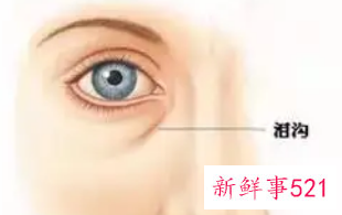 去除泪沟的好手术方法是什么