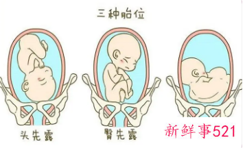 臀位转头位什么感觉