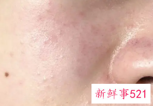 为什么化妆过后脸会痒