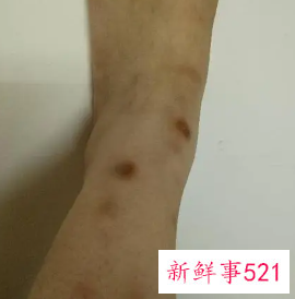 面部跌伤怎样快速去疤痕