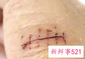 伤口长疤了里面还有脓