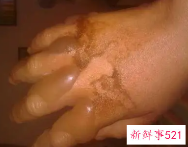 烫伤后破了能抹烫伤膏吗