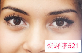 怎么能消除眼袋