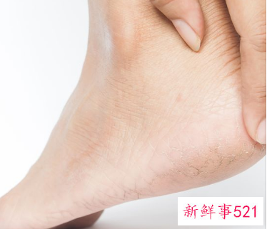 脚上死皮是什么原因