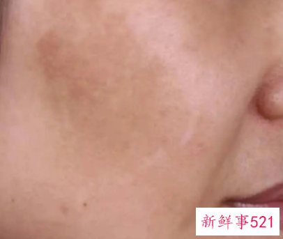 如何去除蝴蝶斑