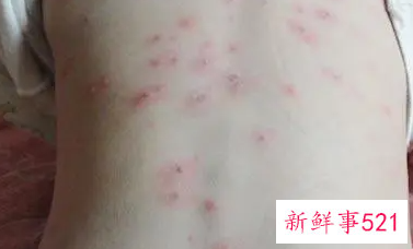 小孩子起水痘怎么治