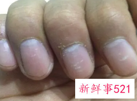 手指指甲出现白点是怎么了