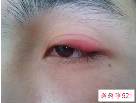 眼睛浮肿怎么办