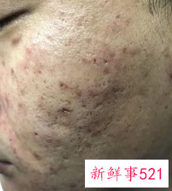 痘印留下色素沉淀怎么办