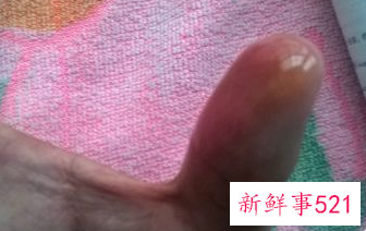 烫住手指头怎么办