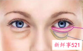 怎么能消除眼袋