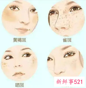 脸上长黑斑有的治吗